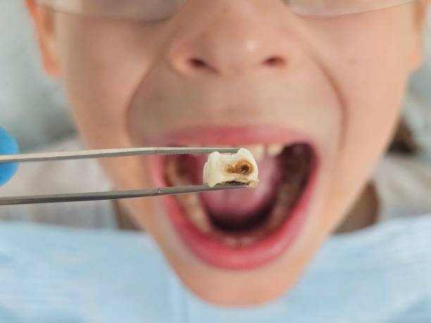 Best Emergency Dentist for Knocked-Out Tooth in West Wood, UT